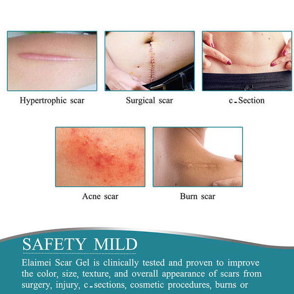 Silicone Scar Tape Roll for C-Section