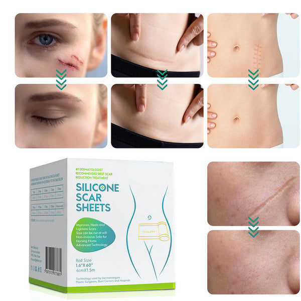 Silicone Scar Tape Roll for C-Section